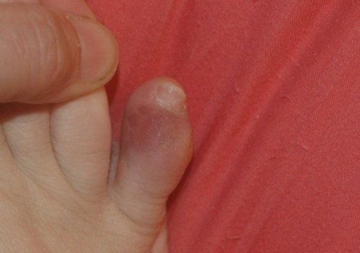 what-causes-cut-under-toe-crease